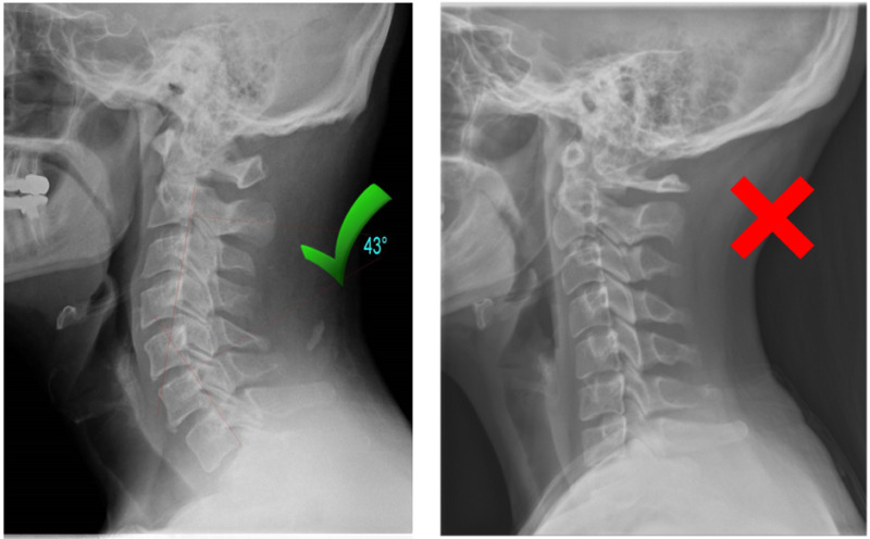 optimal vs suboptimal cervical curve xray