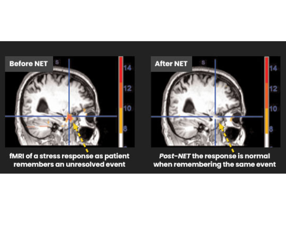fMRI pre and post NET technique showing decreased activity in the primitive brain and stress response and how to decrease symptoms of stress with NET