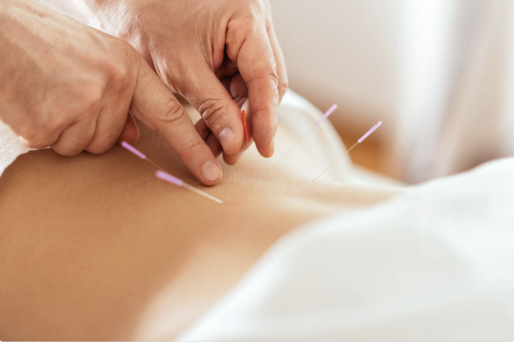 A woman laying on a table getting acupuncture needles placed in her lower back. Traditional Chinese medicine can help to treat body aches and pains.