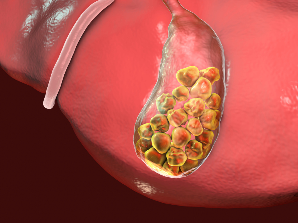 Illustration of gallstones filling up gallbladder to show a cause of gallbladder symptoms and acid reflux pain.
