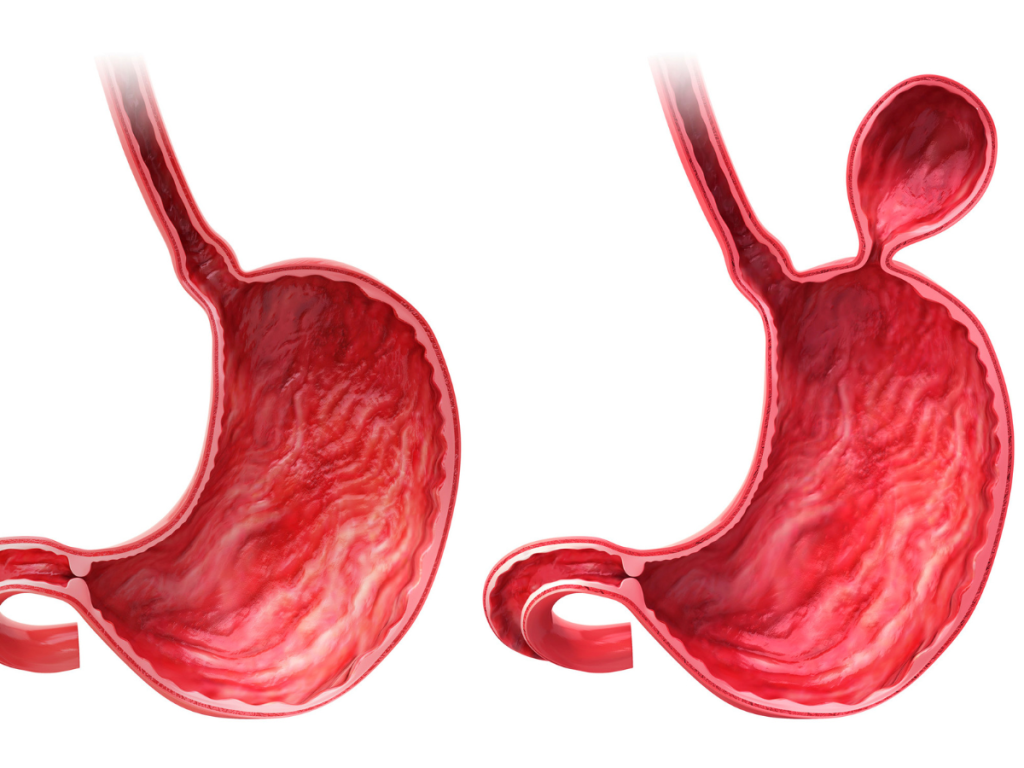 Illustration of hiatal hernia