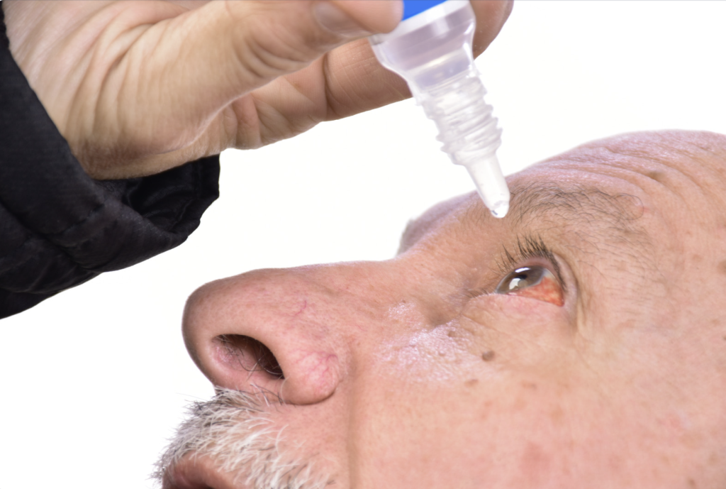 An older man placing eye drops in his reddened eyes