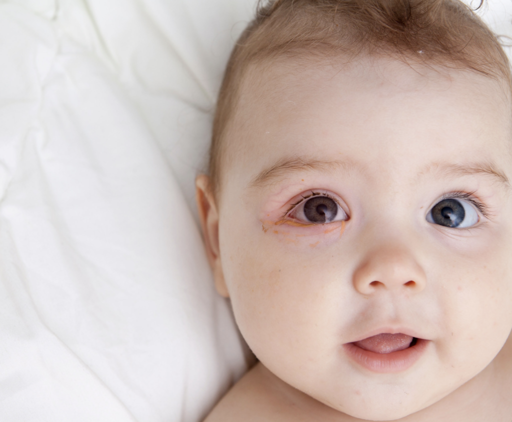 A cute baby laying on his back with his right eye having conjunctivitis in it. Most likely due to an allergy. 